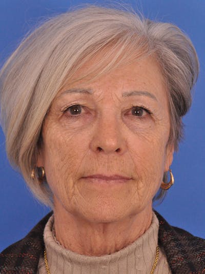 Facelift Before & After Gallery - Patient 436265 - Image 1