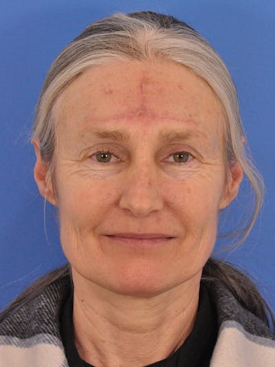 Vbeam Laser Before & After Gallery - Patient 348841 - Image 1