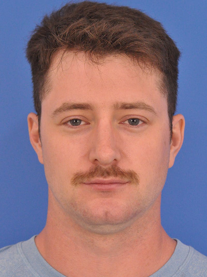 Chin Filler Before & After Gallery - Patient 228531 - Image 6