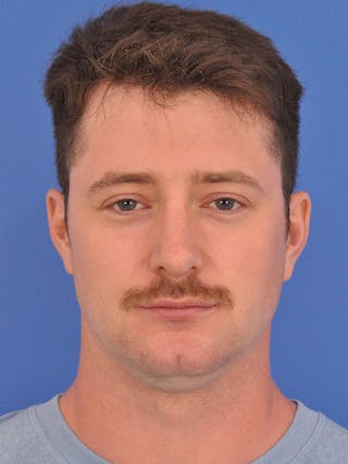 Chin Filler Before & After Gallery - Patient 228531 - Image 6