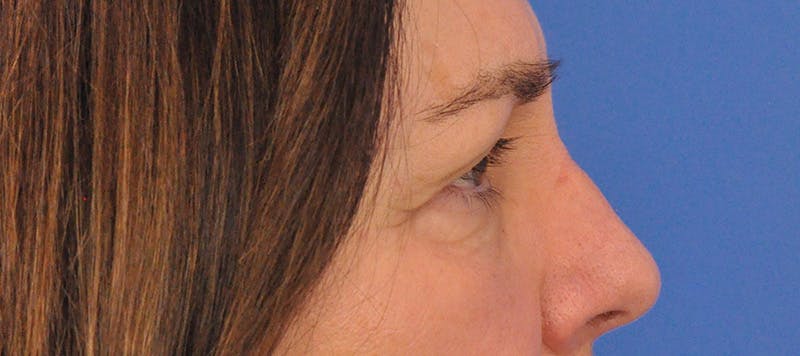 Blepharoplasty Before & After Gallery - Patient 761684 - Image 5