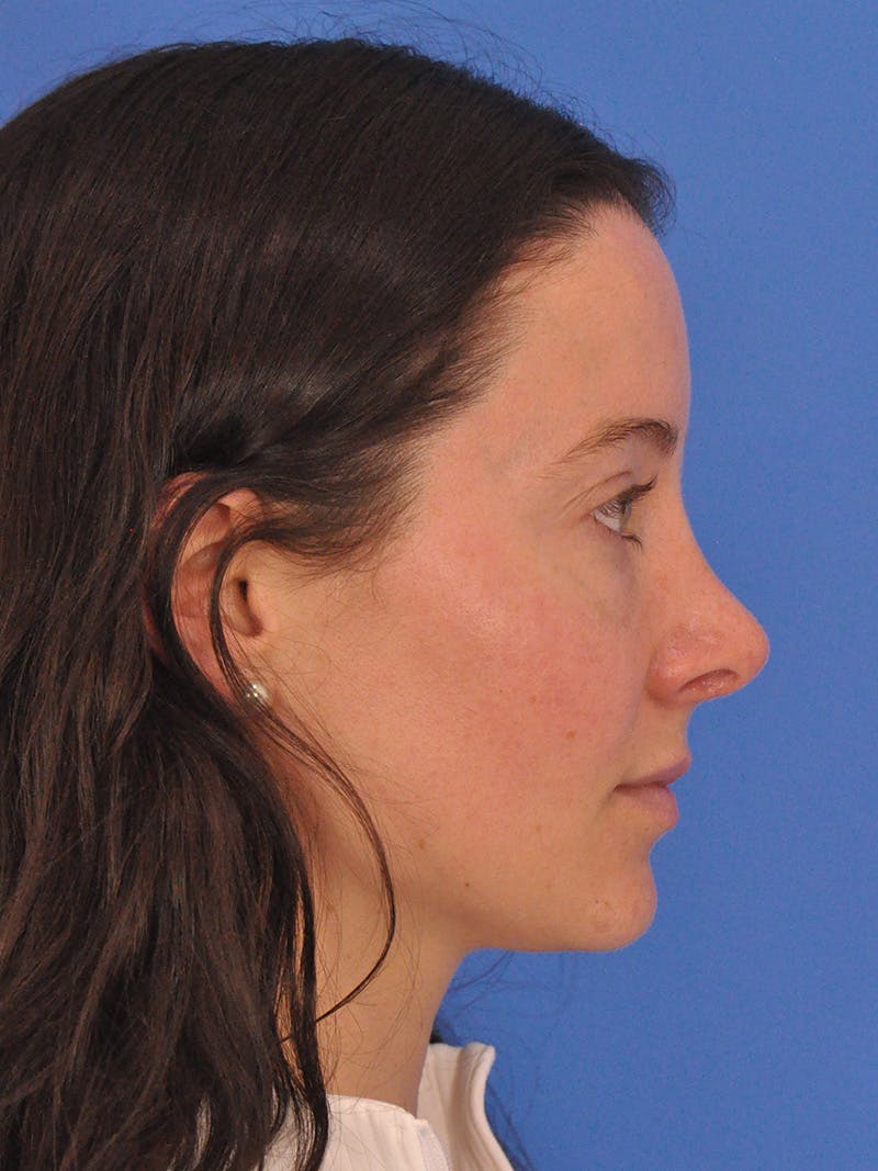 Cheek Filler Before & After Gallery - Patient 385411 - Image 7