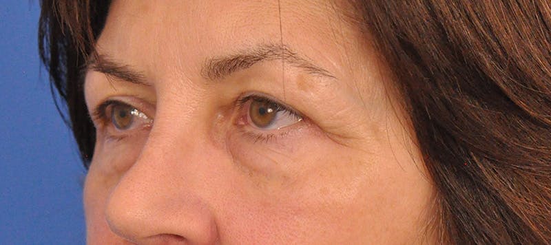 Blepharoplasty Before & After Gallery - Patient 358961 - Image 9