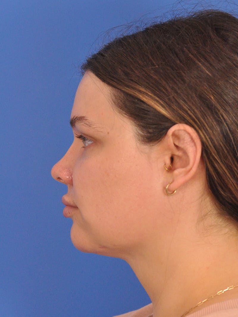 Chin Augmentation Before & After Gallery - Patient 174515 - Image 10