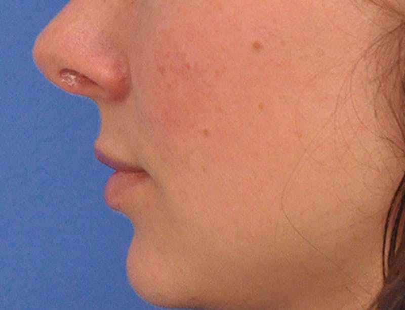 Lip Filler Before & After Gallery - Patient 829353 - Image 12