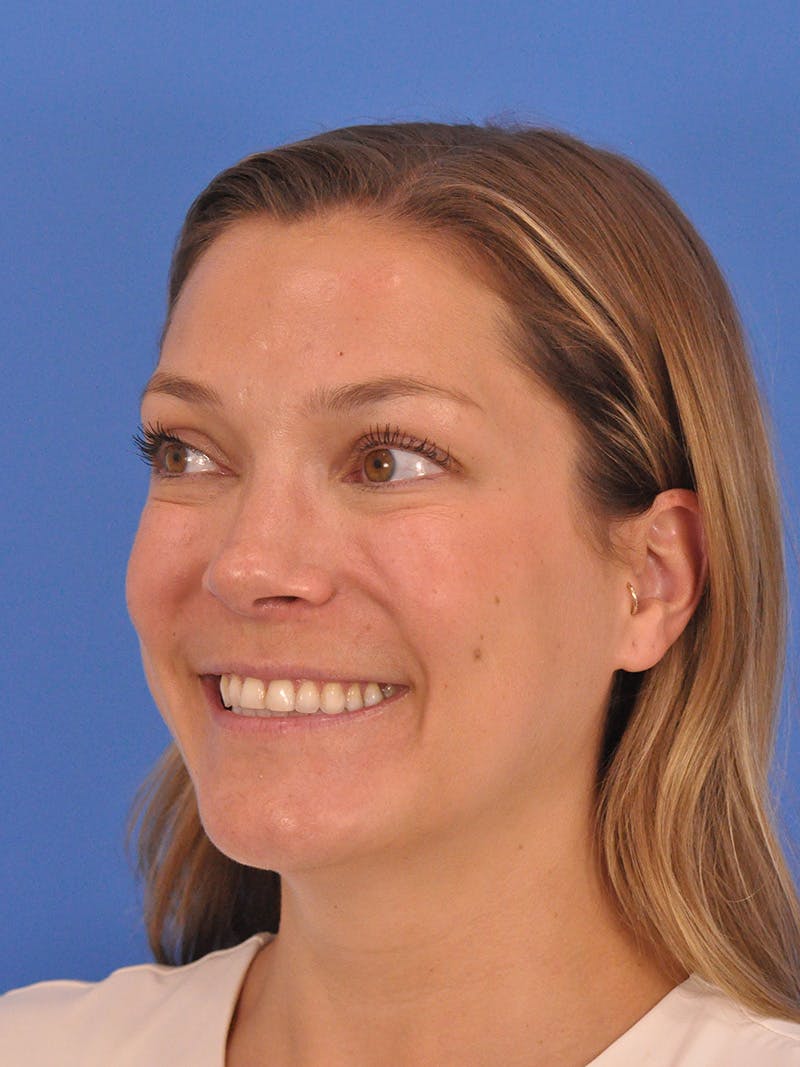 Cheek Filler Before & After Gallery - Patient 187973 - Image 13