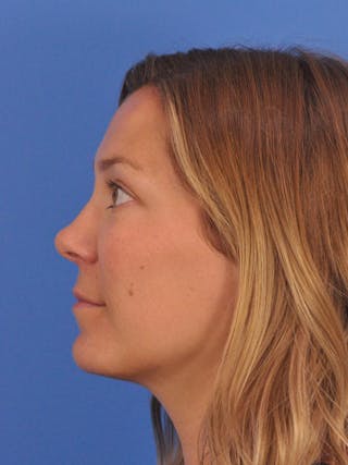 Cheek Filler Before & After Gallery - Patient 187973 - Image 16