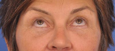 Blepharoplasty Before & After Gallery - Patient 358961 - Image 2