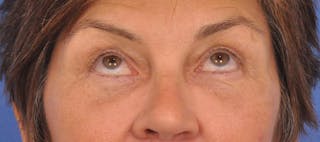 Blepharoplasty Before & After Gallery - Patient 358961 - Image 2