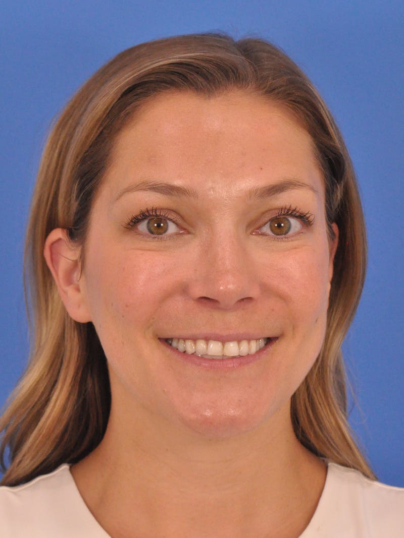 Cheek Filler Before & After Gallery - Patient 187973 - Image 3