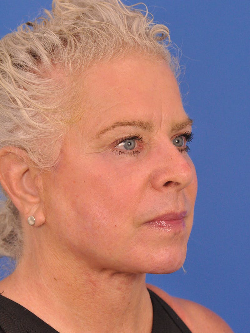 Neck Lift Before & After Gallery - Patient 563465 - Image 4