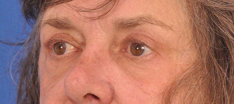 Blepharoplasty Before & After Gallery - Patient 110122 - Image 4