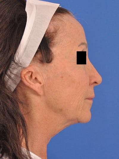 Neck Lift Before & After Gallery - Patient 128768 - Image 1