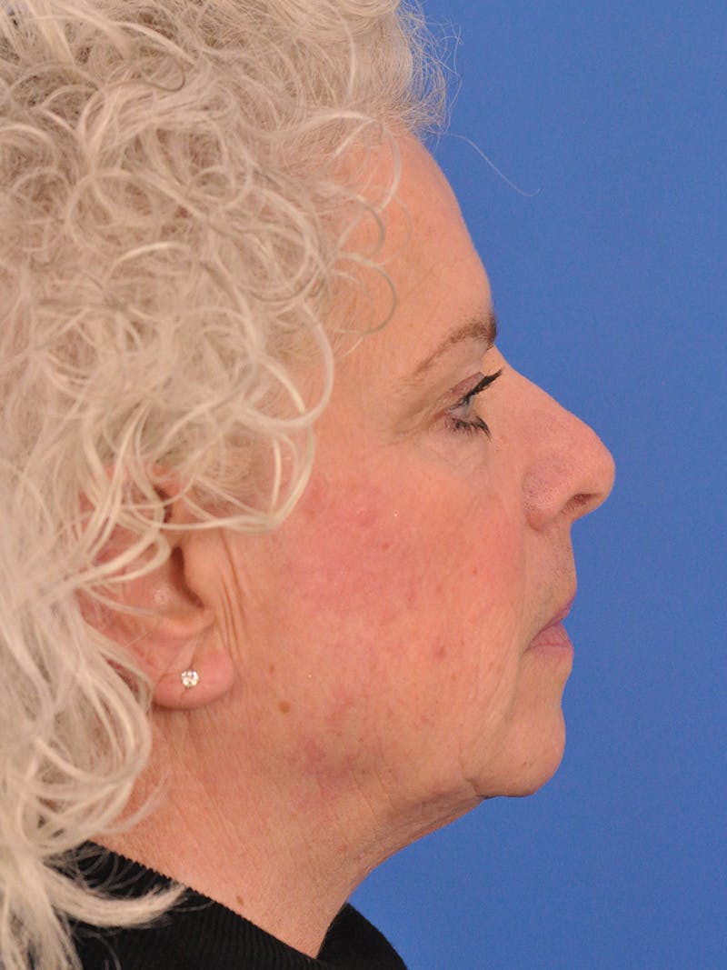 Neck Lift Before & After Gallery - Patient 563465 - Image 1