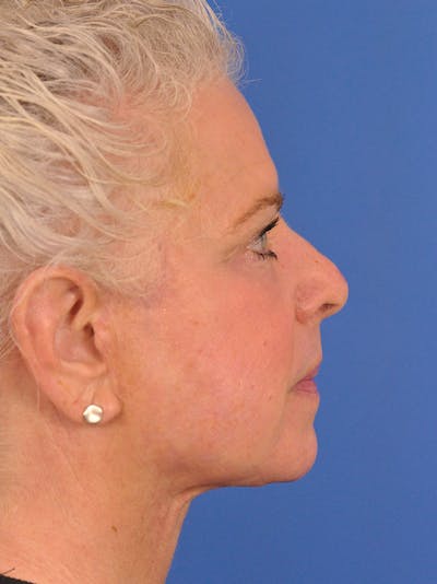 Neck Lift Before & After Gallery - Patient 563465 - Image 2