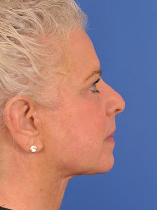 Neck Lift Before & After Gallery - Patient 563465 - Image 2