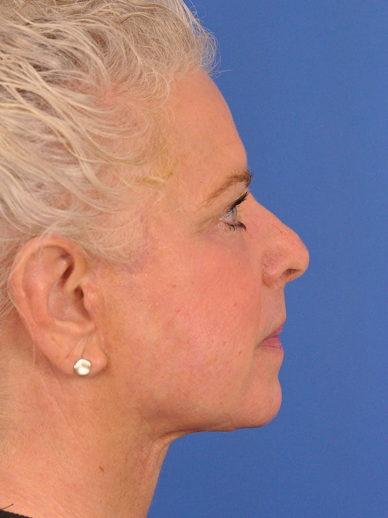 Neck Lift Before & After Gallery - Patient 563465 - Image 2