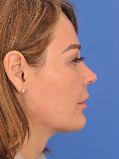 Rhinoplasty Before & After Gallery - Patient 386262 - Image 1