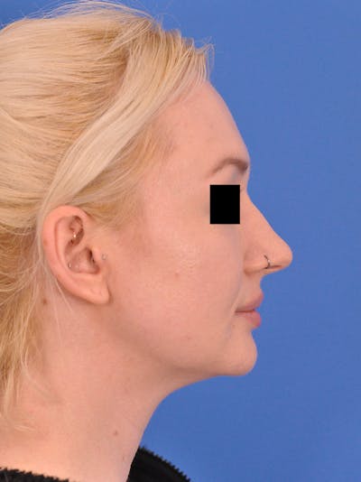 Rhinoplasty Before & After Gallery - Patient 368634 - Image 1