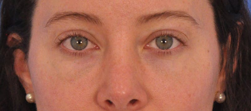 Tear Trough Filler Before & After Gallery - Patient 265185 - Image 3