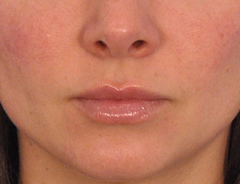 Lip Filler Before & After Gallery - Patient 829353 - Image 4
