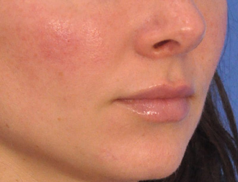Lip Filler Before & After Gallery - Patient 829353 - Image 6