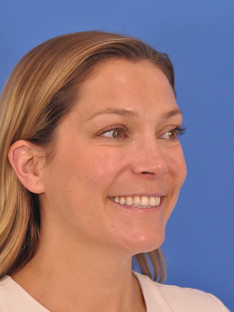 Cheek Filler Before & After Gallery - Patient 187973 - Image 7