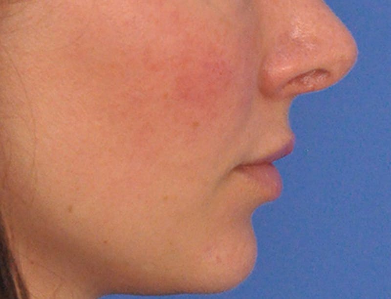Lip Filler Before & After Gallery - Patient 829353 - Image 8