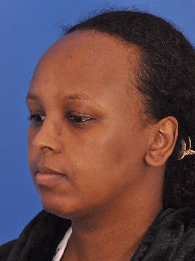 Forehead Reduction Before & After Gallery - Patient 196323 - Image 9