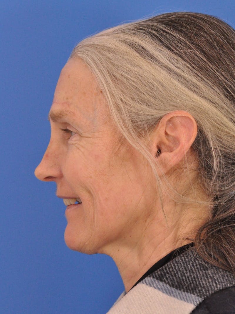 Vbeam Laser Before & After Gallery - Patient 348841 - Image 9
