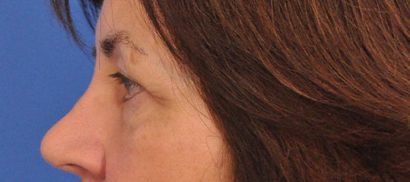 Blepharoplasty Before & After Gallery - Patient 358961 - Image 11