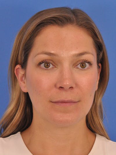 Cheek Filler Before & After Gallery - Patient 187973 - Image 1