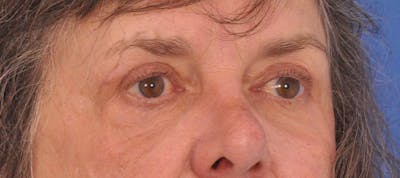 Blepharoplasty Before & After Gallery - Patient 110122 - Image 2