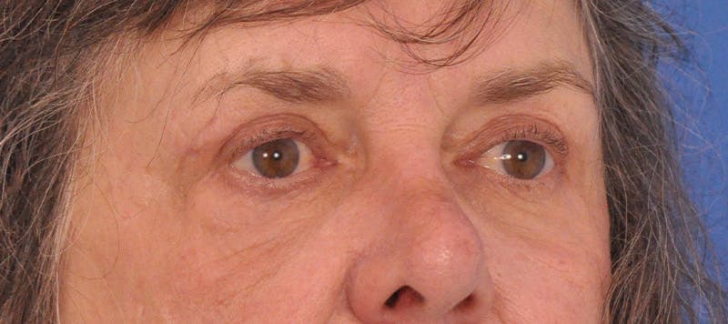 Blepharoplasty Before & After Gallery - Patient 110122 - Image 2