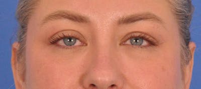 Blepharoplasty Before & After Gallery - Patient 391503 - Image 1