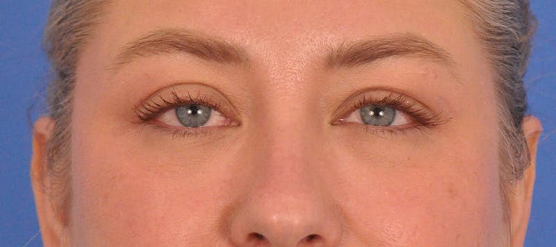Blepharoplasty Before & After Gallery - Patient 391503 - Image 1