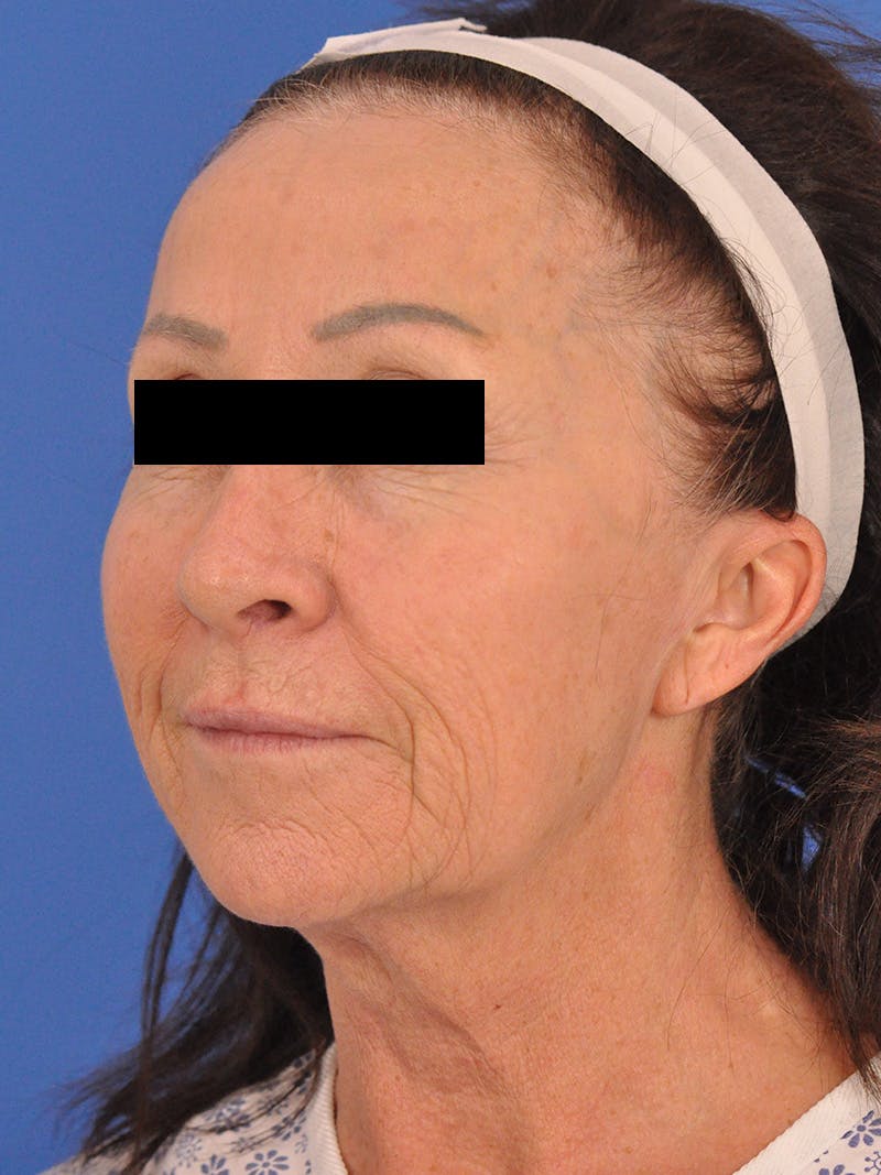 Neck Lift Before & After Gallery - Patient 128768 - Image 7