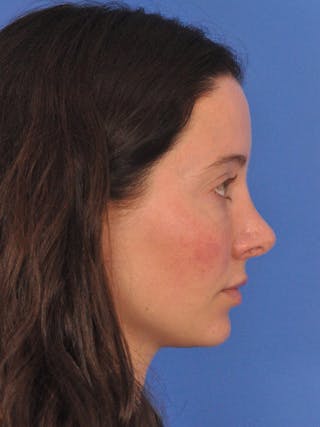 Cheek Filler Before & After Gallery - Patient 385411 - Image 8
