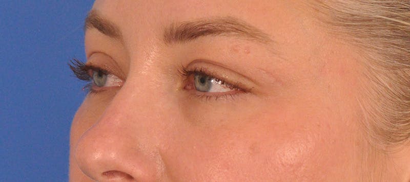 Blepharoplasty Before & After Gallery - Patient 391503 - Image 9
