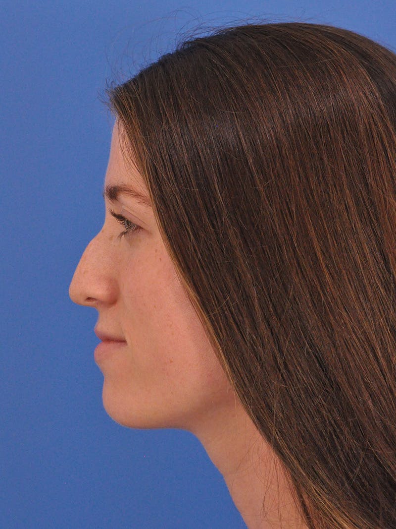 Liquid Rhinoplasty Before & After Gallery - Patient 395172 - Image 11