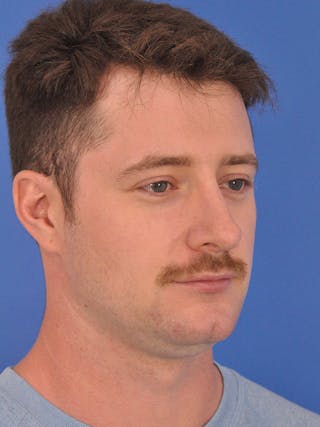 Chin Filler Before & After Gallery - Patient 228531 - Image 4