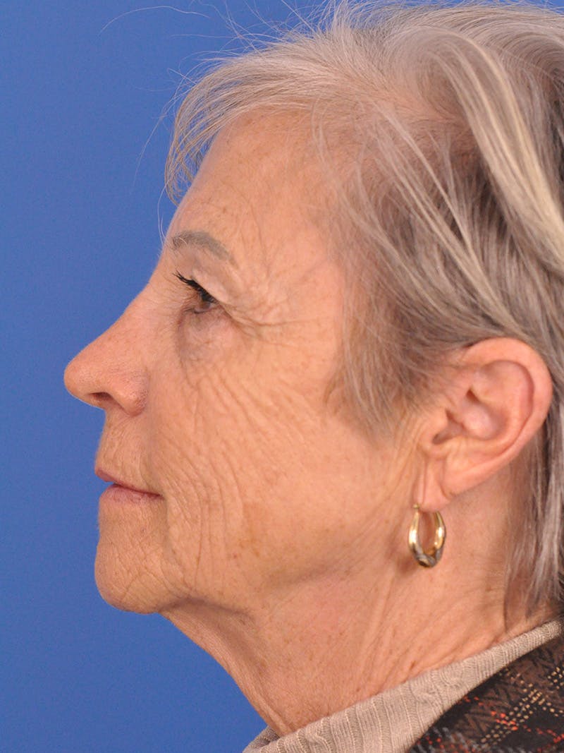 Neck Lift Before & After Gallery - Patient 181998 - Image 9
