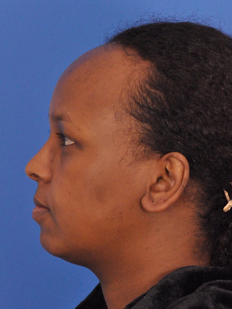 Forehead Reduction Before & After Gallery - Patient 196323 - Image 11