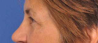 Blepharoplasty Before & After Gallery - Patient 358961 - Image 12