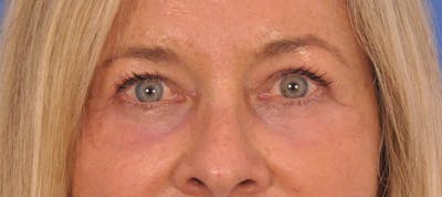 Blepharoplasty Before & After Gallery - Patient 376126 - Image 2