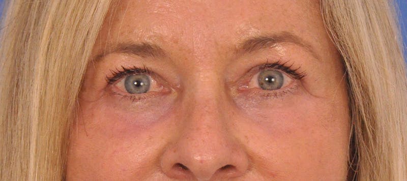 CO2RE Laser Before & After Gallery - Patient 140276 - Image 2