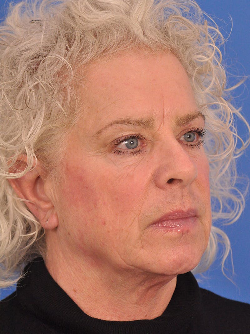 Neck Lift Before & After Gallery - Patient 563465 - Image 3