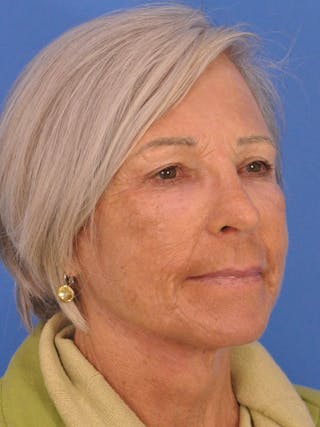 Blepharoplasty Before & After Gallery - Patient 341741 - Image 4