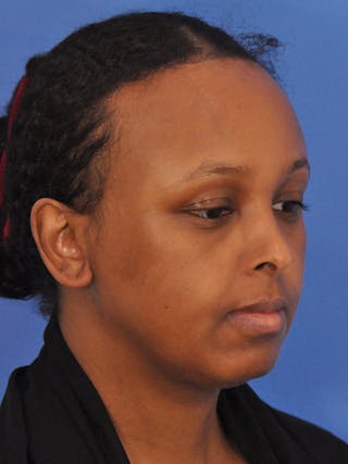 Forehead Reduction Before & After Gallery - Patient 196323 - Image 6