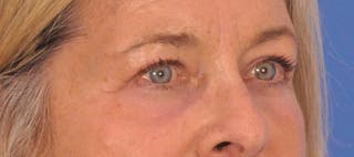 CO2RE Laser Before & After Gallery - Patient 140276 - Image 6